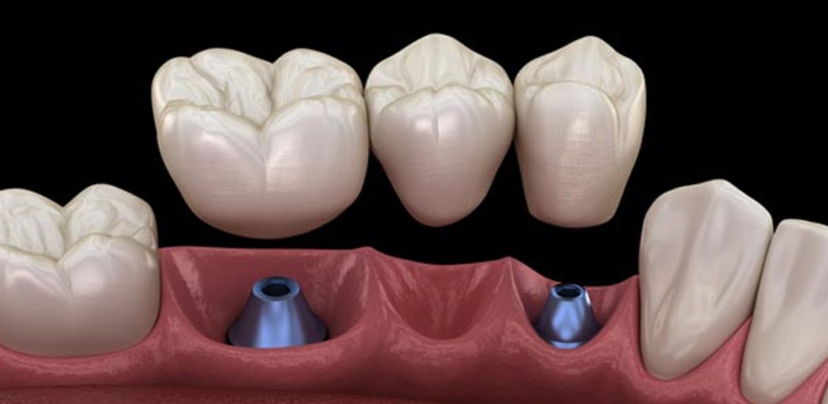 Visual guide of dental bridge installation