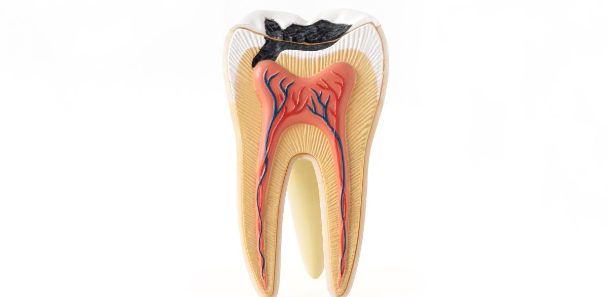 Cross-section of a tooth showing deep cavity