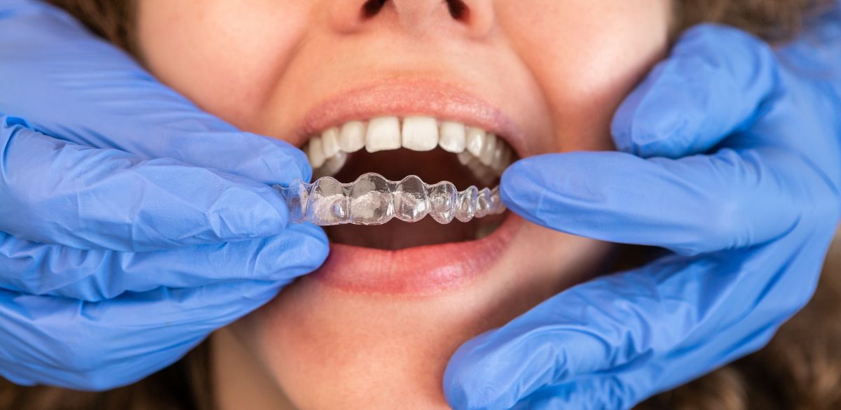 Dental professional fitting clear aligners on a smiling patient