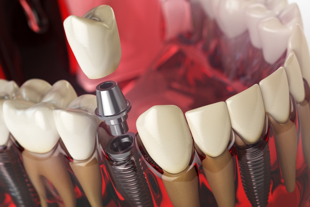 Dental Implants Grants Pass