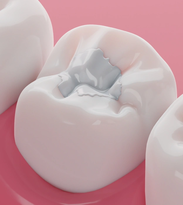 Illustration of composite fillings