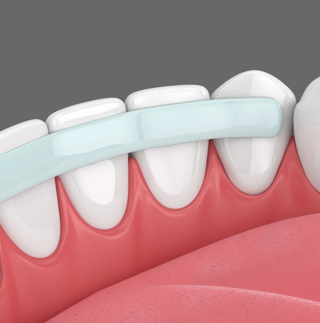 Illustration of dental bonding