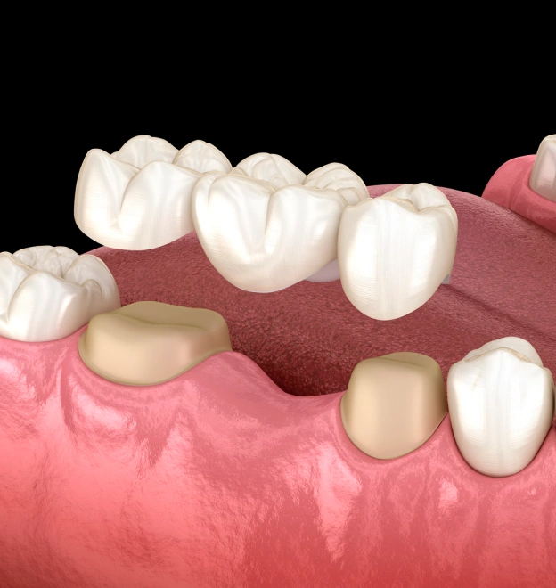 Illustration of dental bridges