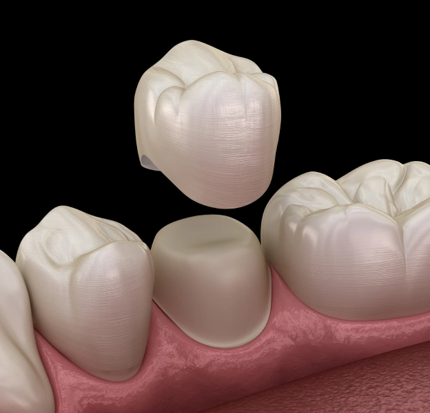 Illustration of dental crowns