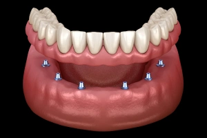 Illustration of full arch implants