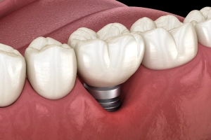 Illustration of mini implants