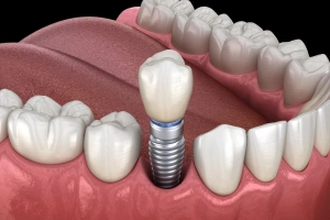 Illustration of single tooth implants